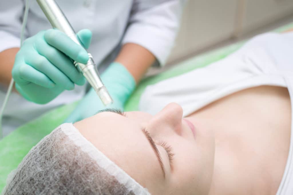 How Does Microneedling Help With Aging Skin