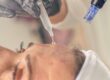 Microneedling