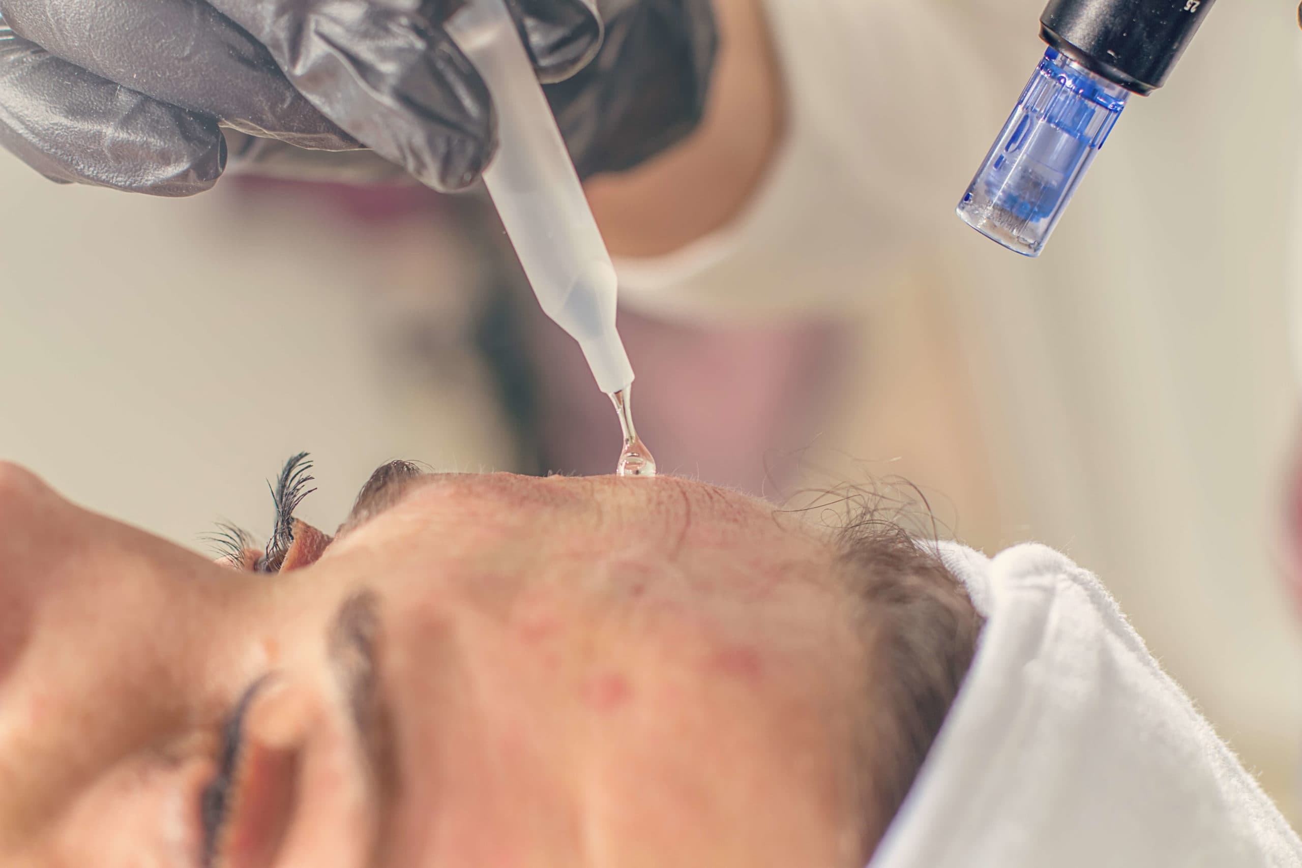 Microneedling