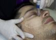 The Power of Microneedling | Studio Medical Aesthetics