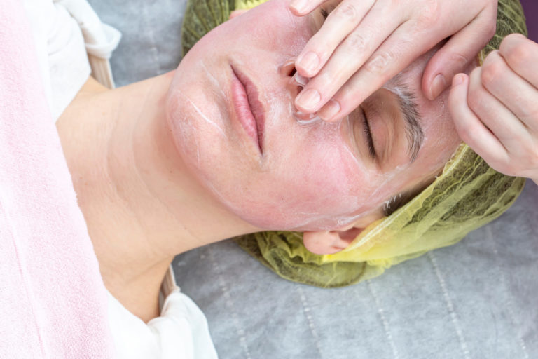 Can Acne Scars be Treated by Chemical Peeling