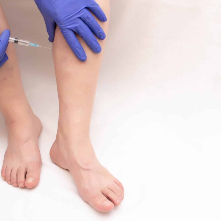 Sclerotherapy