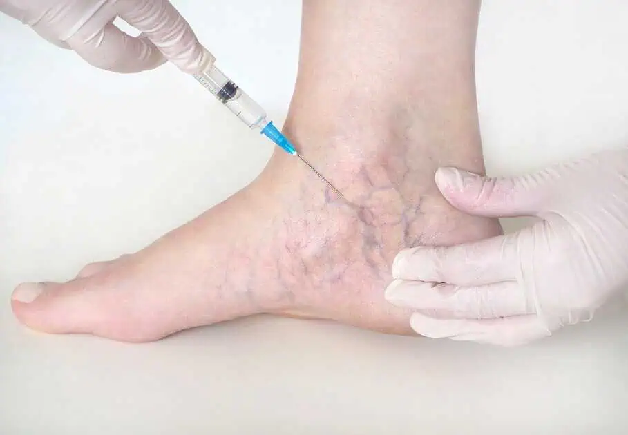 Sclerotherapy In Newport & Georgetown, KY by Studio Medical Aesthetics