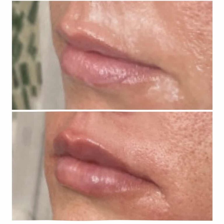 Dermal Fillers treatment at Newport, Lexington, KY