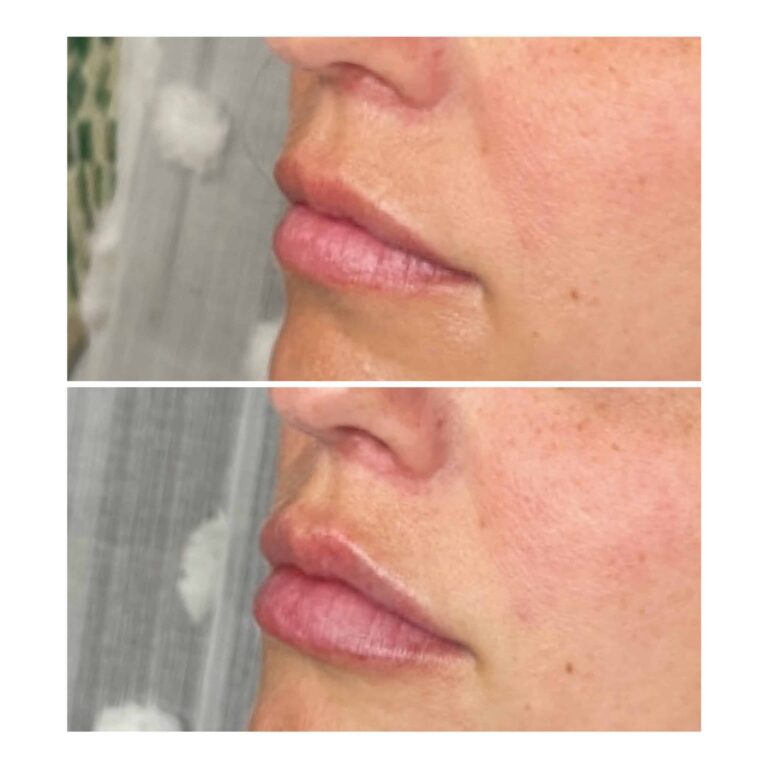 Dermal Fillers treatment at Newport, Lexington, KY