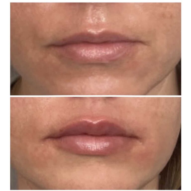 Dermal Fillers treatment at Newport, Lexington, KY