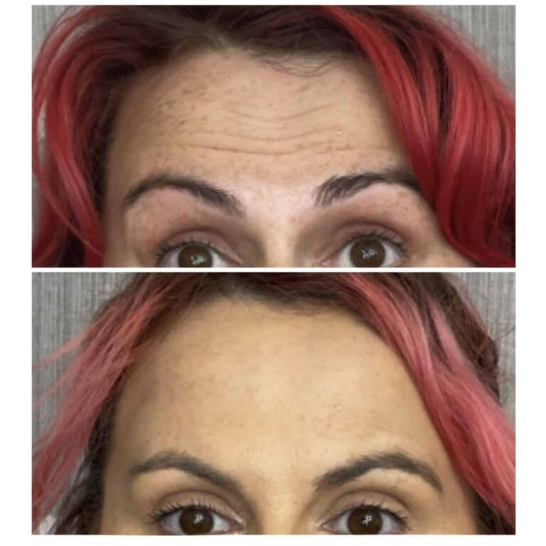 Neurotoxin treatment at Newport, Lexington, KY