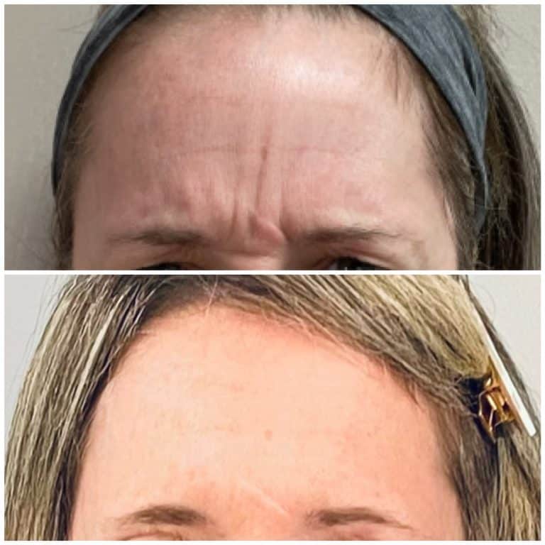 Neurotoxin treatment at Newport, Lexington, KY