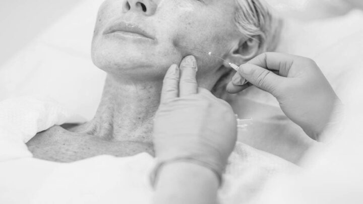 PDO Thread Lift: Lift your Jaw, Neckline, Brows, Mid Face & More PDO Thread Lift: Lift your Jaw, Neckline, Brows, Mid Face & More