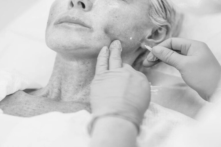 PDO Thread Lift: Lift your Jaw, Neckline, Brows, Mid Face & More