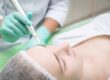 Microneedling