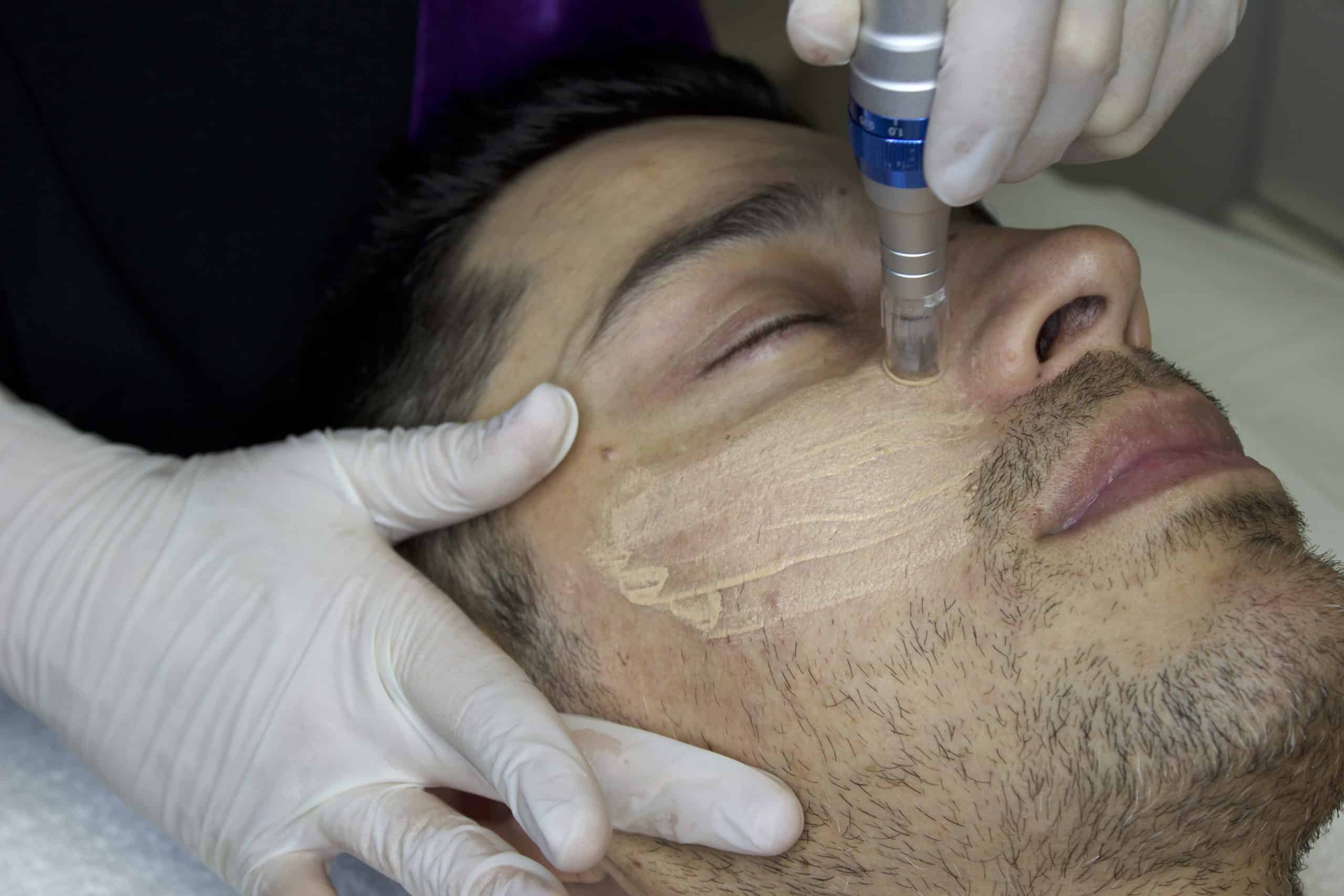 The Power of Microneedling | Studio Medical Aesthetics