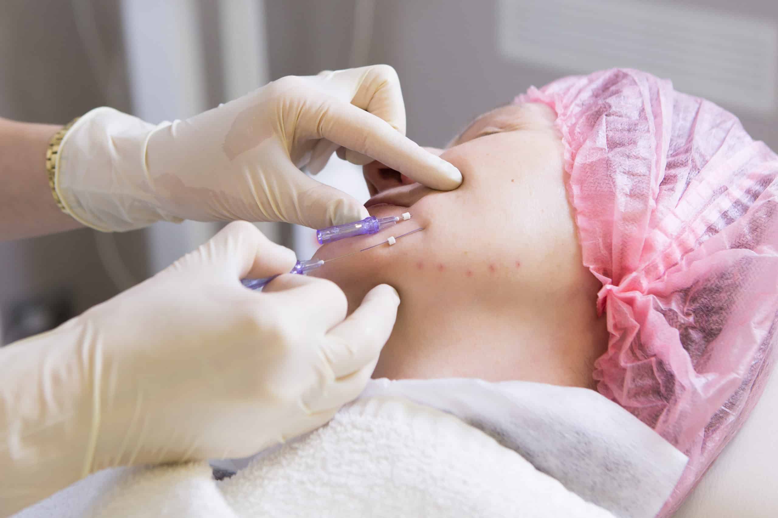 What is the PDO Used in Thread Lift